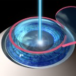 Vài nét về phẩu thuật Lasik